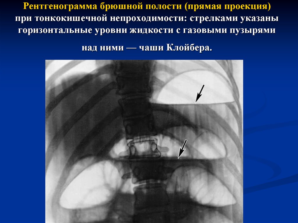 Полость свободно. Кишечная непроходимость рентген чаши Клойбера. Кишечная непроходимость рентген тонкокишечная. Рентген брюшной полости чаши Клойбера. Острая кишечная непроходимость чаши Клойбера.