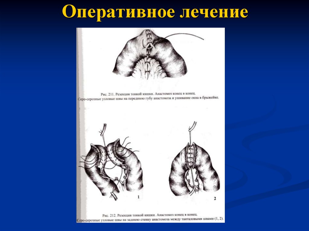 Острая кишечная непроходимость госпитальная хирургия презентация