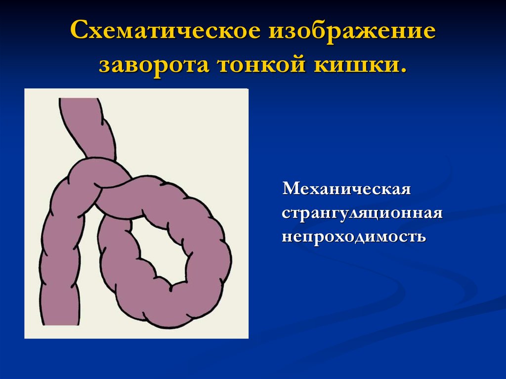 Приобретенная кишечная непроходимость у детей презентация