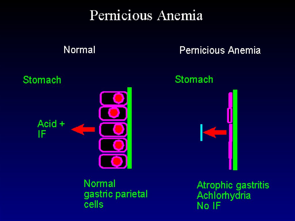 Megaloblastic anemia - online presentation