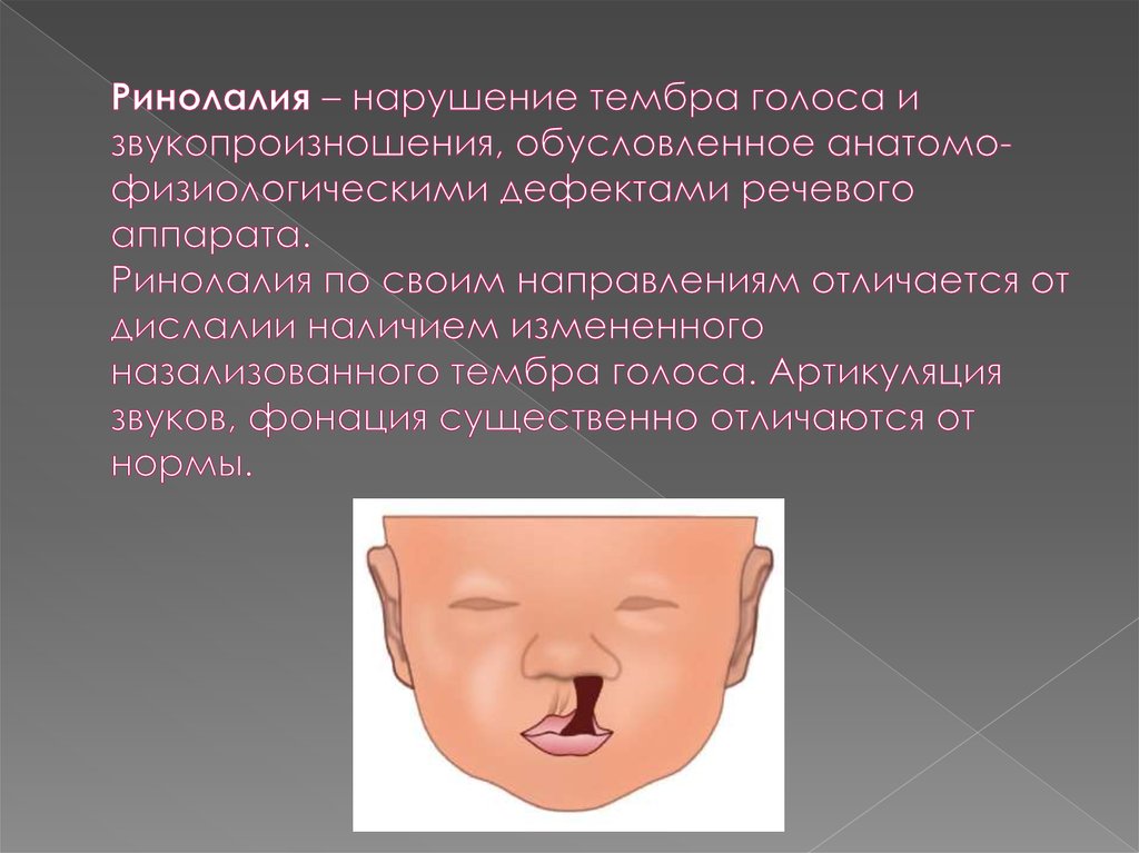 Произношение свистящих звуков при открытой ринолалии - online presentation