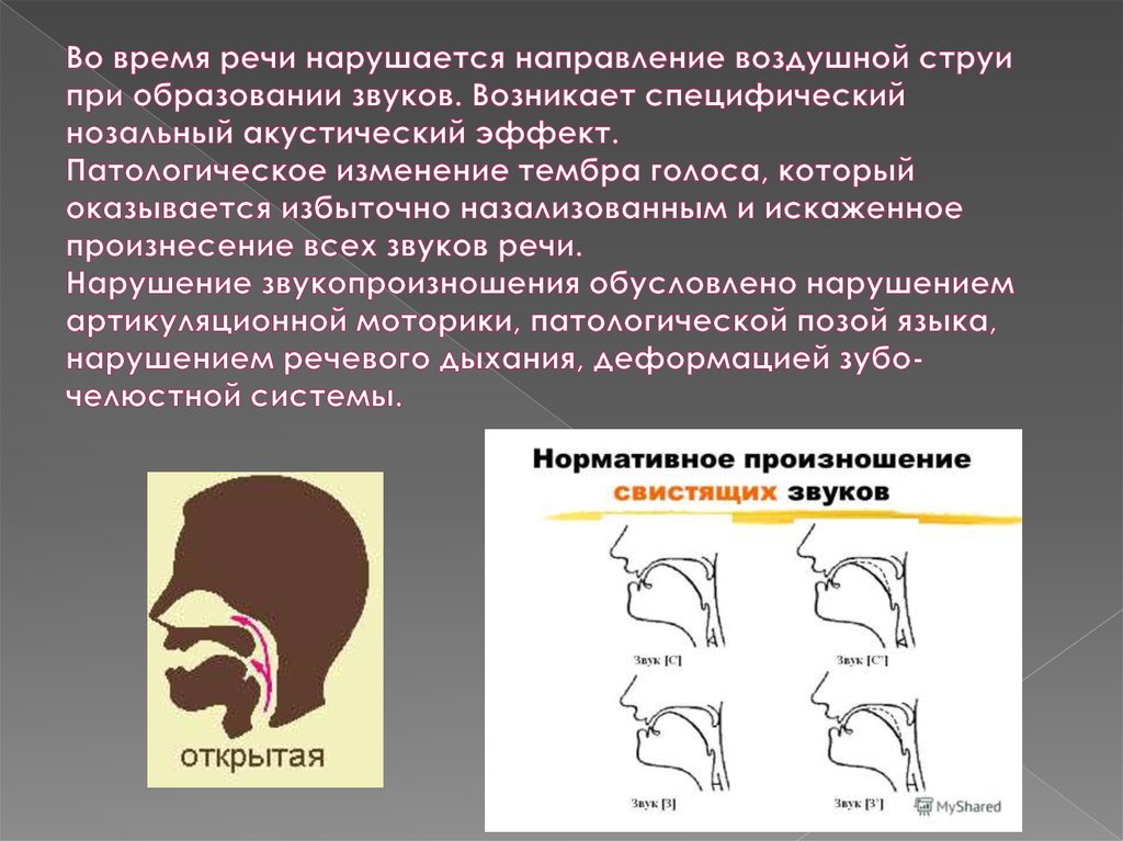 Произношение звуков речи. Профили артикуляции свистящих звуков при ринолалии. Положение языка при ринолалии. Положение языка при открытой ринолалии. Нарушения свистящих при ринолалии.