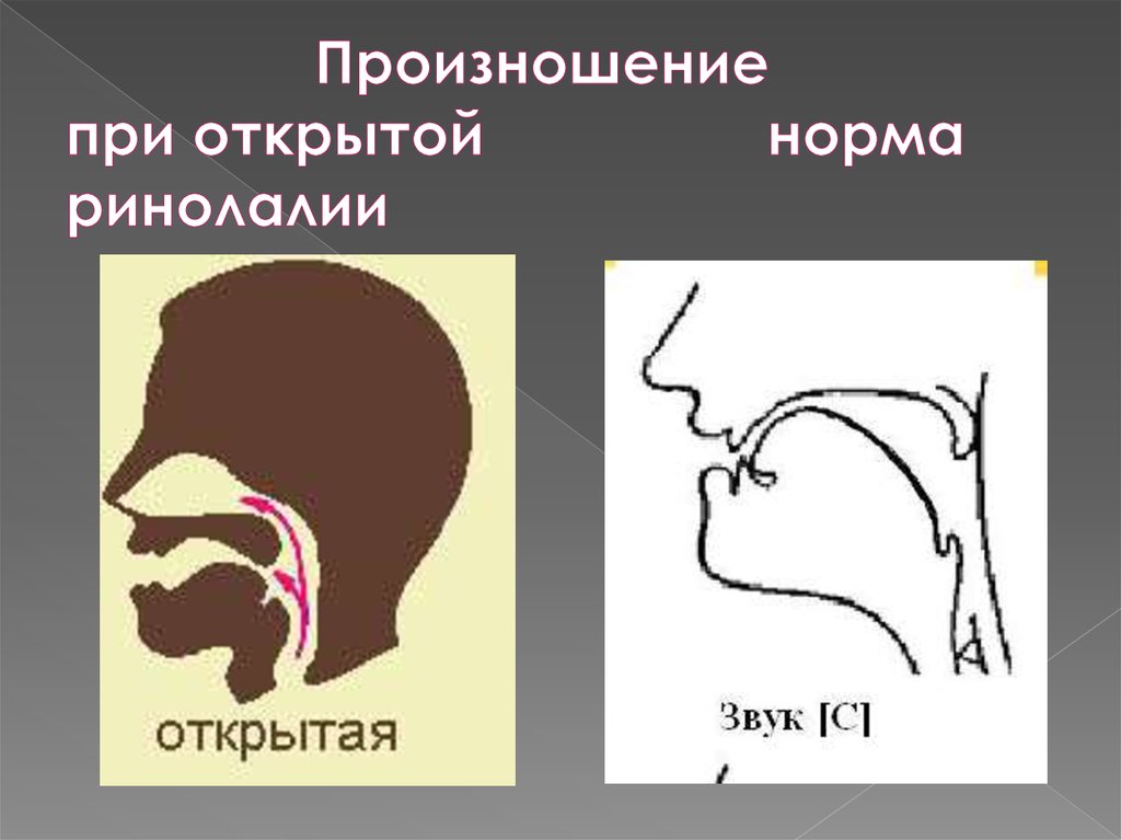 Схема взаимосвязи звуков при ринолалии