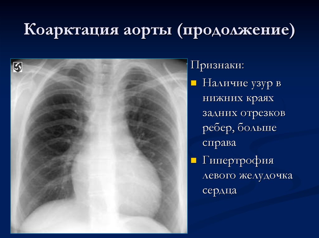 Больше справа. Коарктация аорты рентген. Коарктация аорты ребра рентген. Рентгенограмма при коарктации аорты. Рентгенография при коарктация аорты.