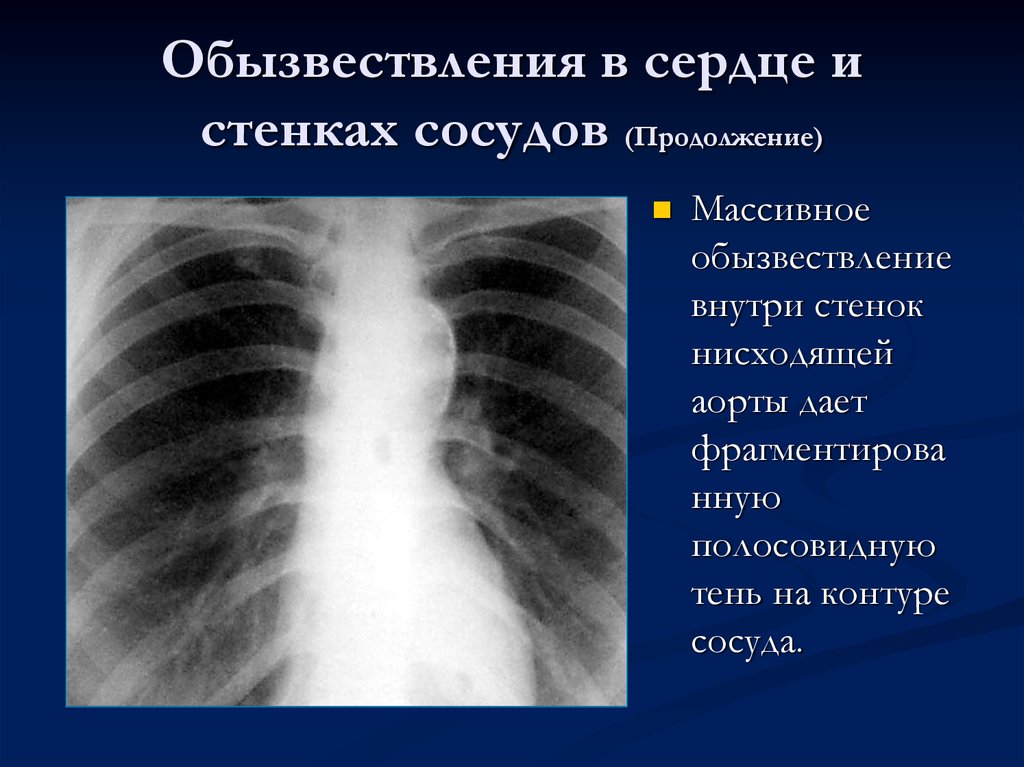 Обызвествление. Кальциноз аорты рентген. Кальциноз аортального клапана на рентгене. Кальциноз аорты на рентгенограмме. Обыствлением стенок сосудов.