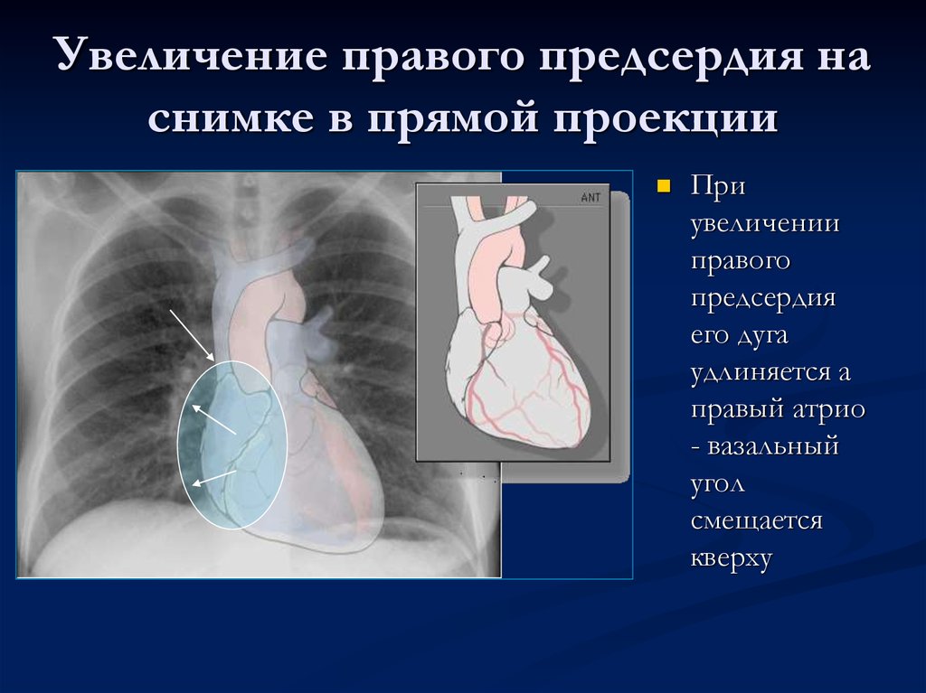 Дилатация правых отделов. Гипертрофия левого желудочка сердца рентген. Увеличение правого предсердия рентген. Гипертрофия правого предсердия рентген. Гипертрофия правого предсердия на рентгенограмме.