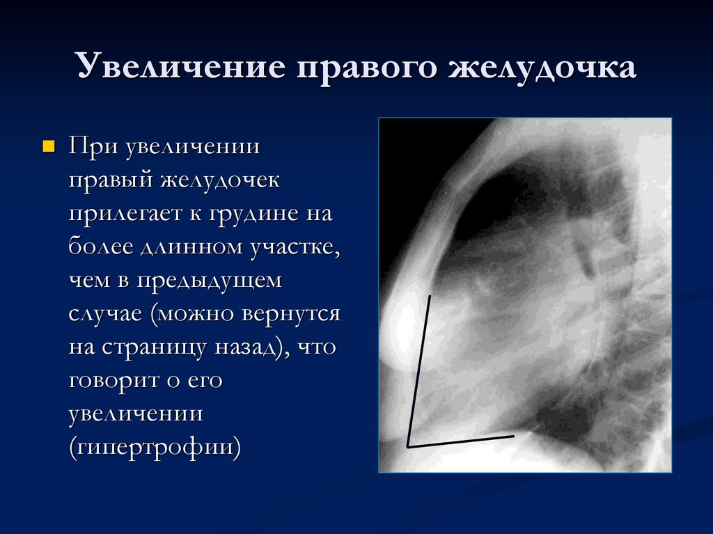 Желудочка сердца расширена. Гипертрофия правого желудочка рентген. Дилатация правого желудочка рентген. Увеличение левого желудочка на рентгене. Гипертрофия правого желудочка на рентгенограмме.