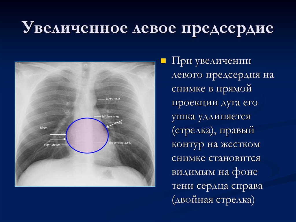 Расширение сердца влево. Левое предсердие на рентгене. Расширение левых отделов сердца на рентгенограмме. Тень сердца расширена рентген.