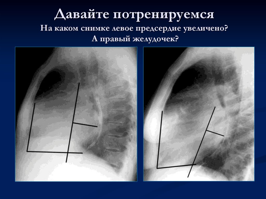 Увеличено левое. Гипертрофия правого предсердия рентген. Гипертрофия правого желудочка рентген. Увеличение левого предсердия рентген. Увеличение правого предсердия на рентгенограмме.