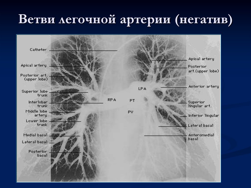 Ветви в легких. Сегментарные ветви легочной артерии. Легочные артерии анатомия. Строение легочной артерии. Анатомия легочных артерий кт.