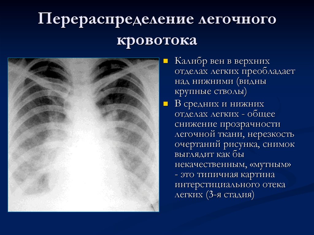 Рисунок усилен в прикорневых отделах. Интерстициальный отек легких рентген. Рентген при отеке легких. Рентген картина отека легких. Отёк лёгких на рентгене описание.