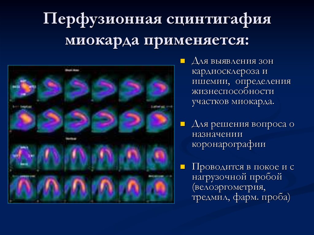 Презентация сцинтиграфия миокарда