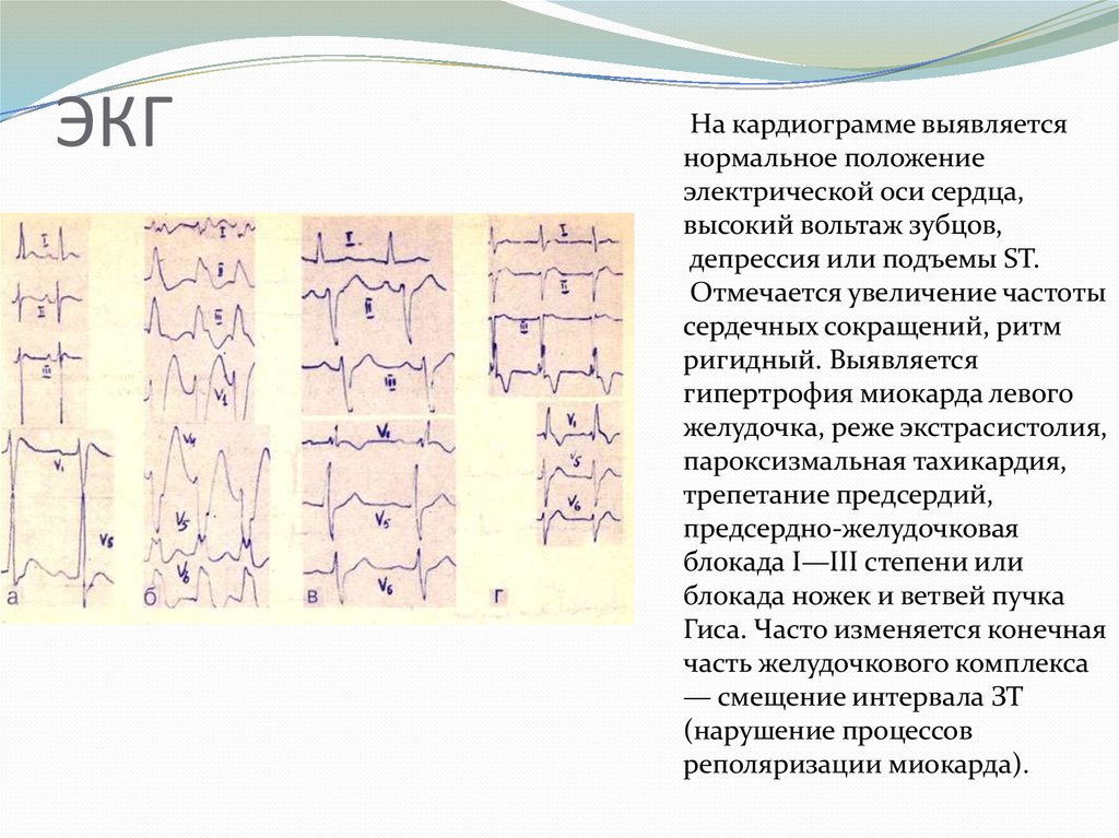 ЭКГ