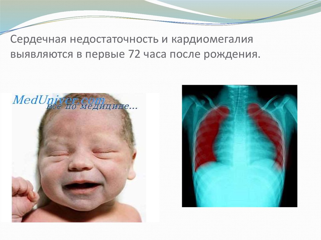 Сердечная недостаточность и кардиомегалия выявляются в первые 72 часа после рождения.