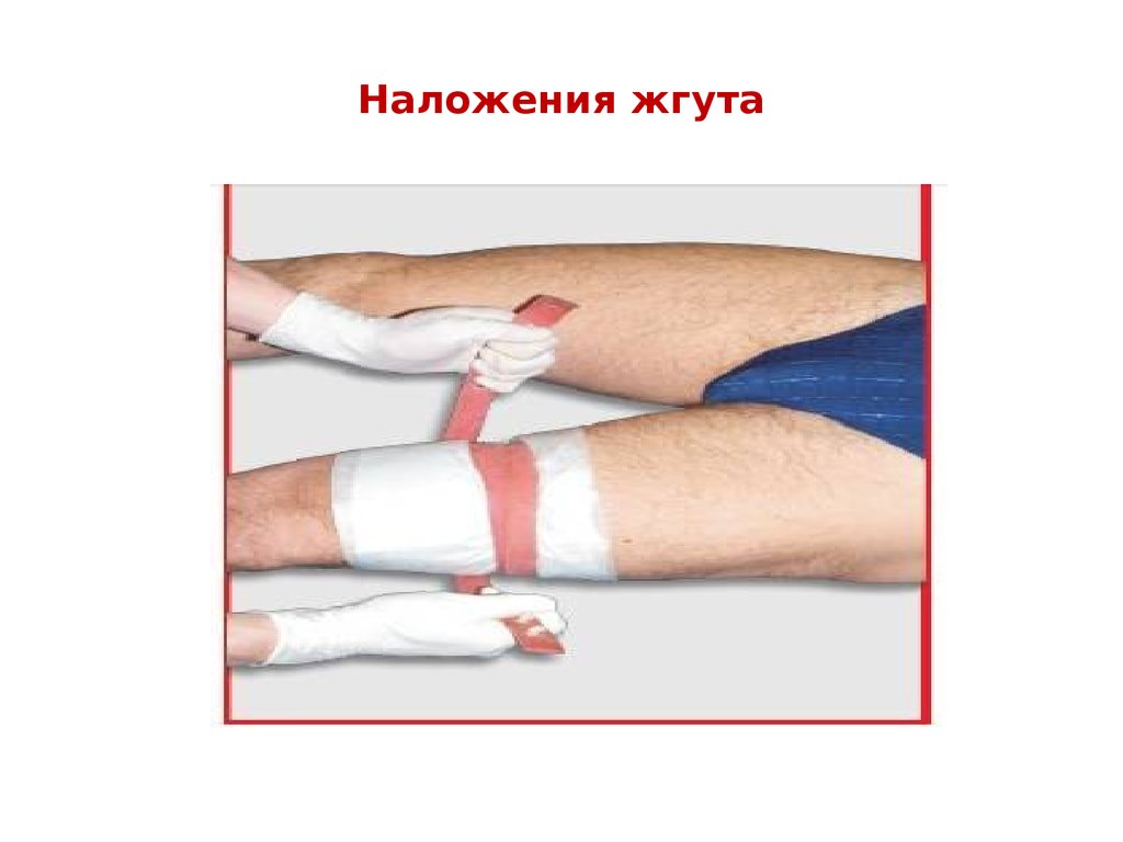 Наложения жгута