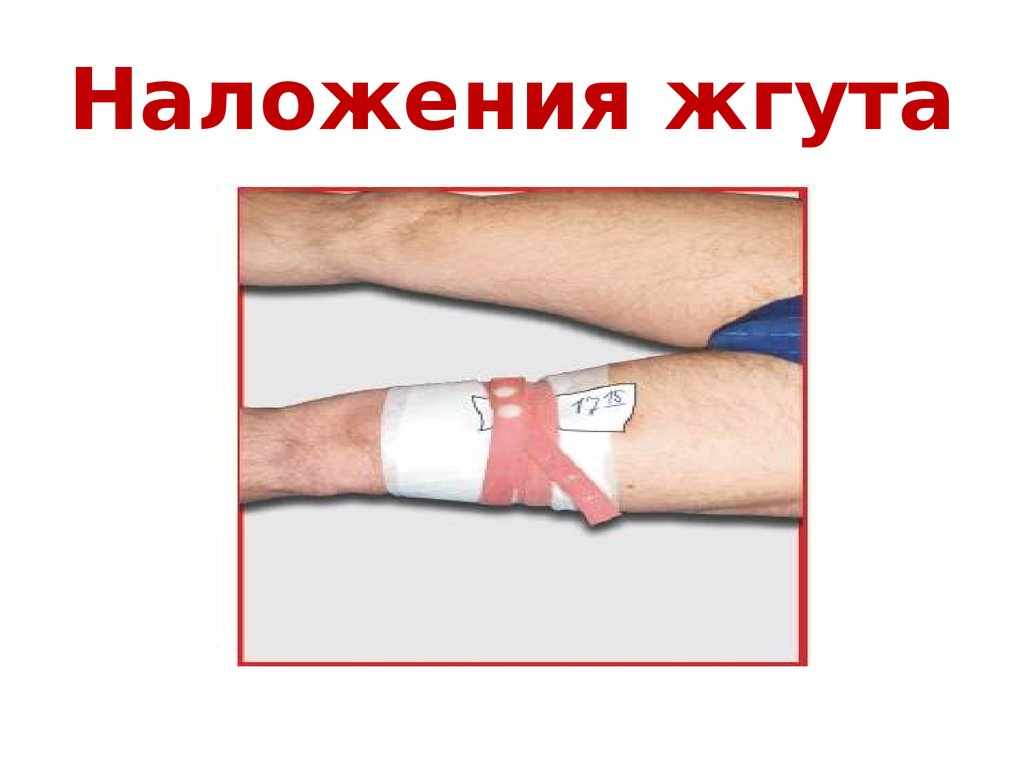 Наложения жгута