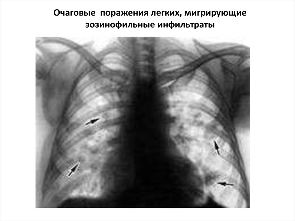 Очаговое поражение легких. Эозинофильный инфильтрат легкого рентген. Эозинофильный инфильтрат рентген. Эозинофильный инфильтрат в легких. Мелкоочаговая инфильтрация.