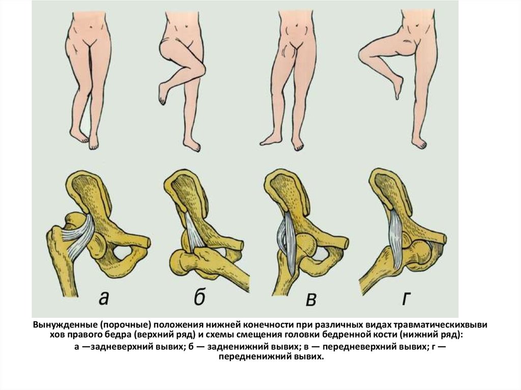 Вывих бедра. Седалищный вывих бедра. Вывихи тазобедренного сустава классификация. Подвывих тазобедренного сустава классификация.