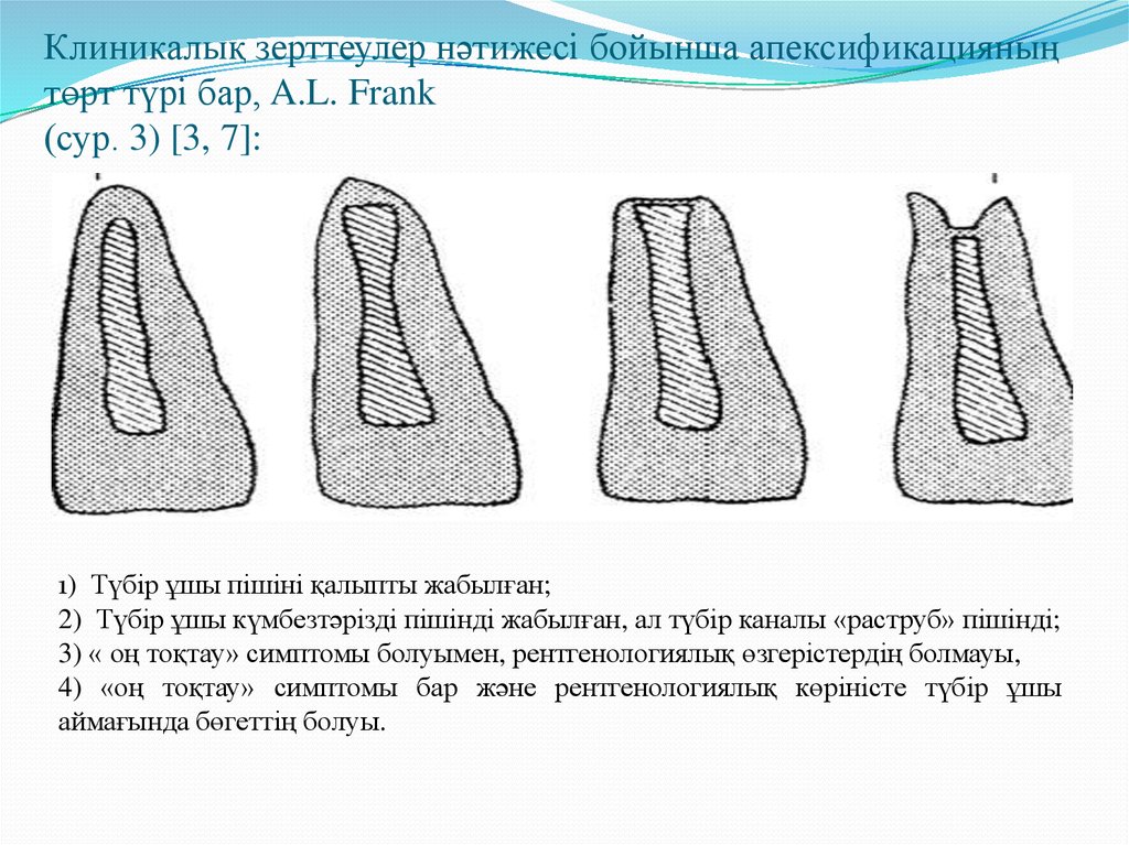 Клиникалық зерттеулер нәтижесі бойынша апексификацияның төрт түрі бар, A.L. Frank (сур. 3) [3, 7]: