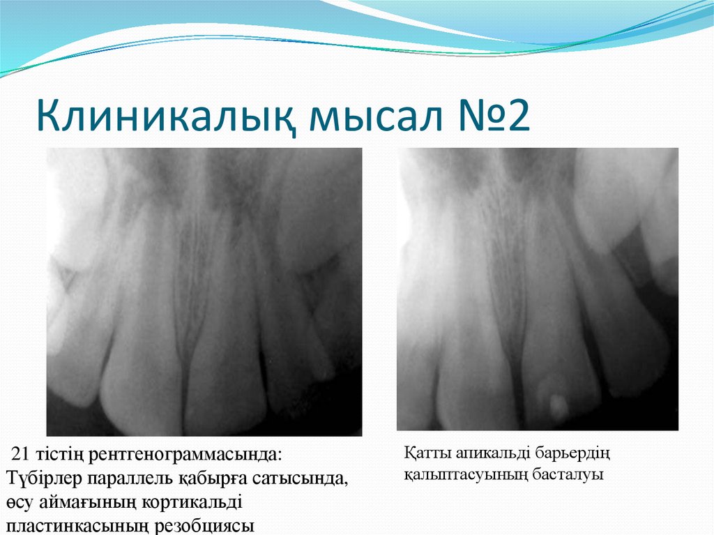Клиникалық мысал №2
