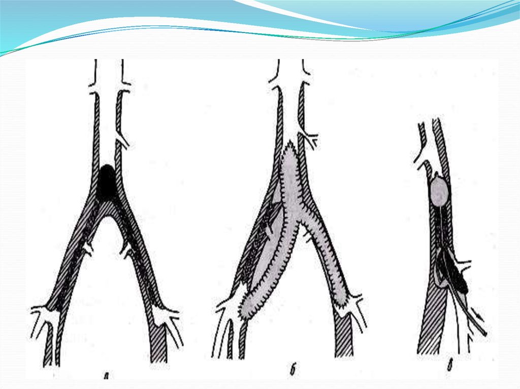 Операция на артерии нижних. Атеросклероз артерий нижних конечностей операция. Атеросклероз сосудов нижних конечностей хирургия. Облитерирующий атеросклероз сосудов конечностей. Облитерирующий атеросклероз аорты.