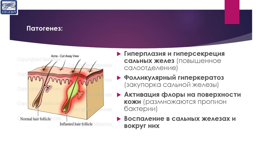 Патогенез акне схема