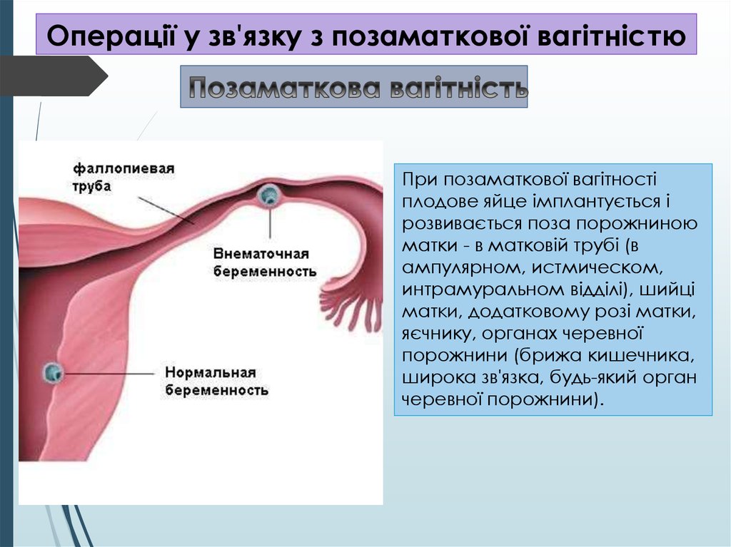 Внематочная беременность операция сроки. Внематочная беременность. Внематочная беременность симптомы. Причины внематочной беременности.