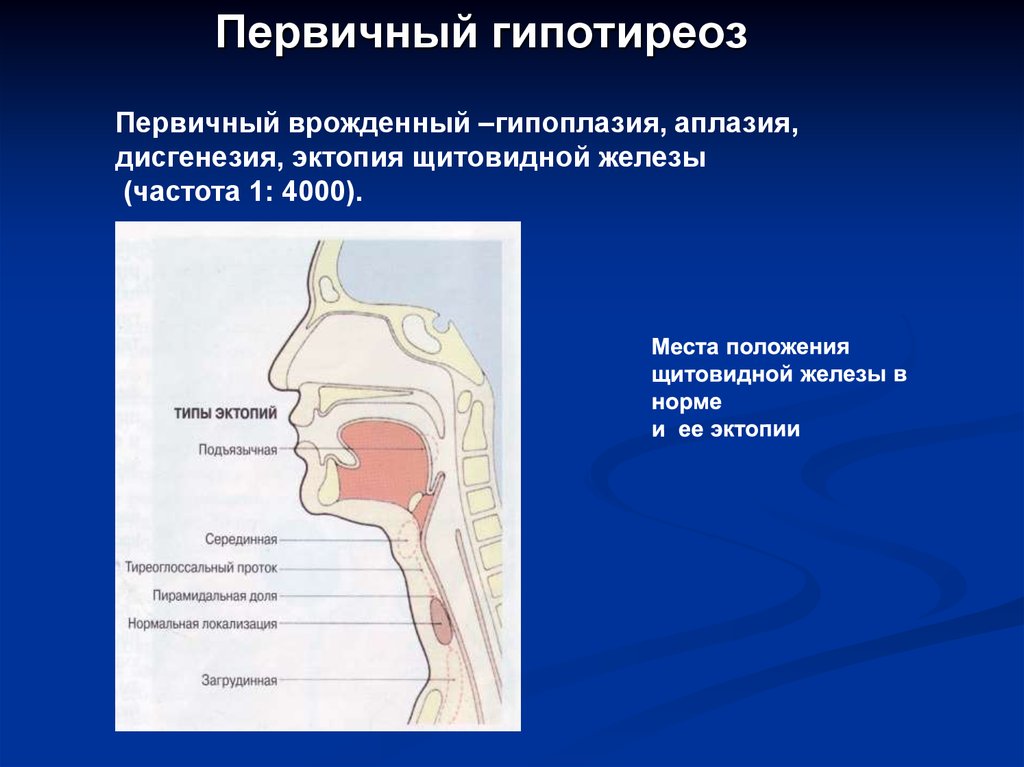 Аплазия щитовидной железы. Аплазия и гипоплазия щитовидной железы. Эхопризнаки гипоплазии щитовидной железы. Эктопия щитовидной железы. Первичный гипотиреоз дисгенезия.