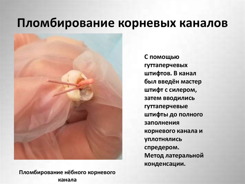 Пломбирование корневых каналов