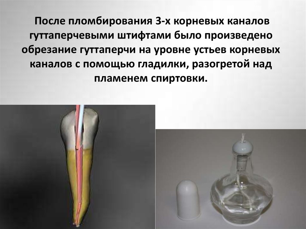 После пломбирования 3-х корневых каналов гуттаперчевыми штифтами было произведено обрезание гуттаперчи на уровне устьев
