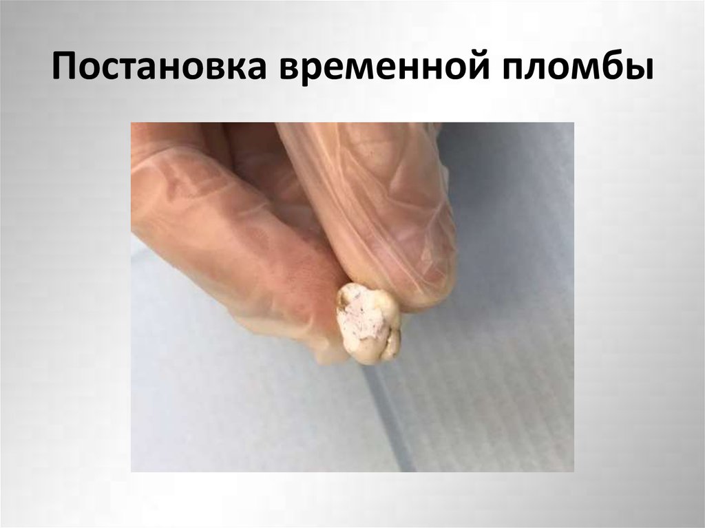 Постановка временной пломбы