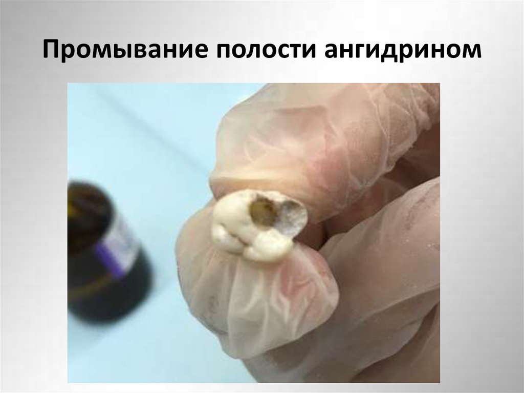 Промывание полости ангидрином