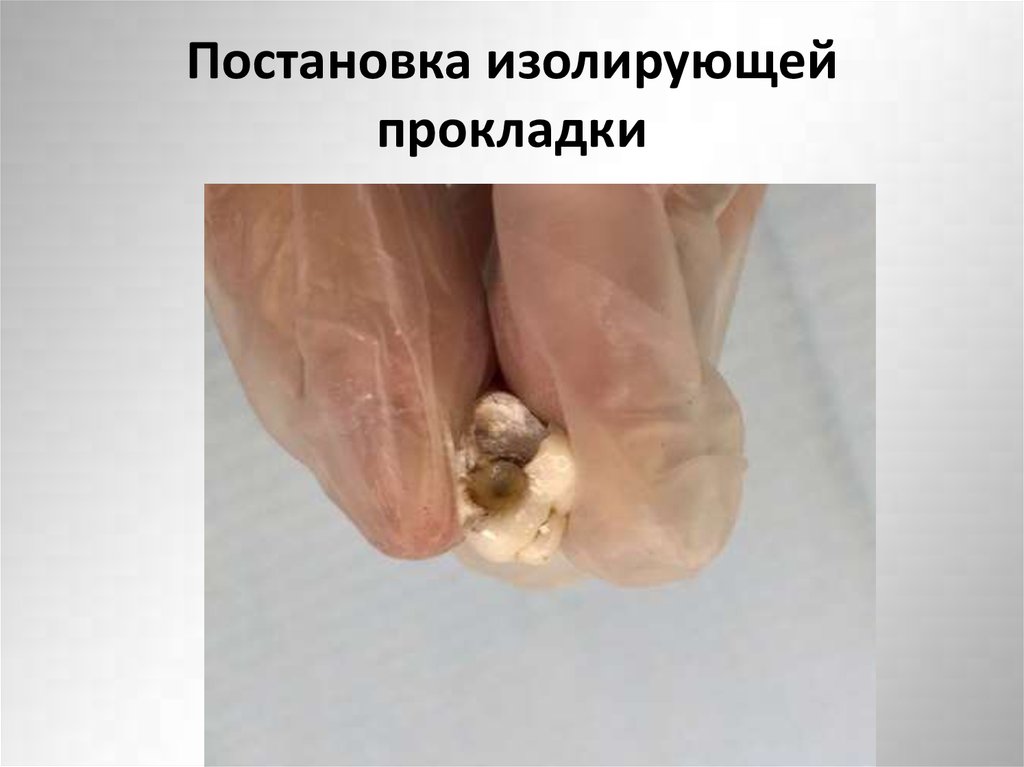 Постановка изолирующей прокладки