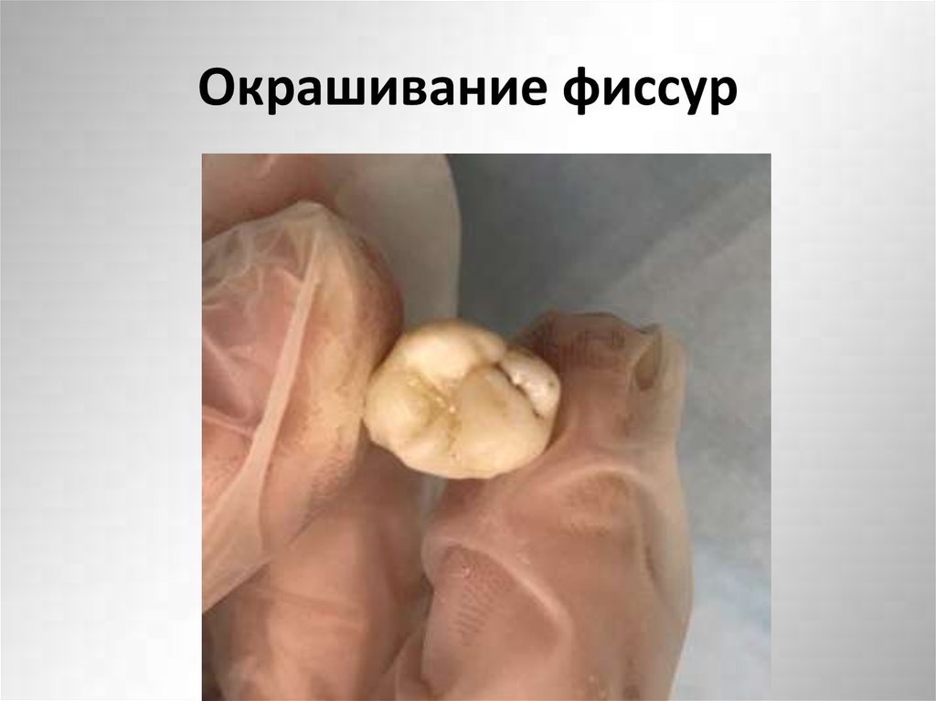 Окрашивание фиссур