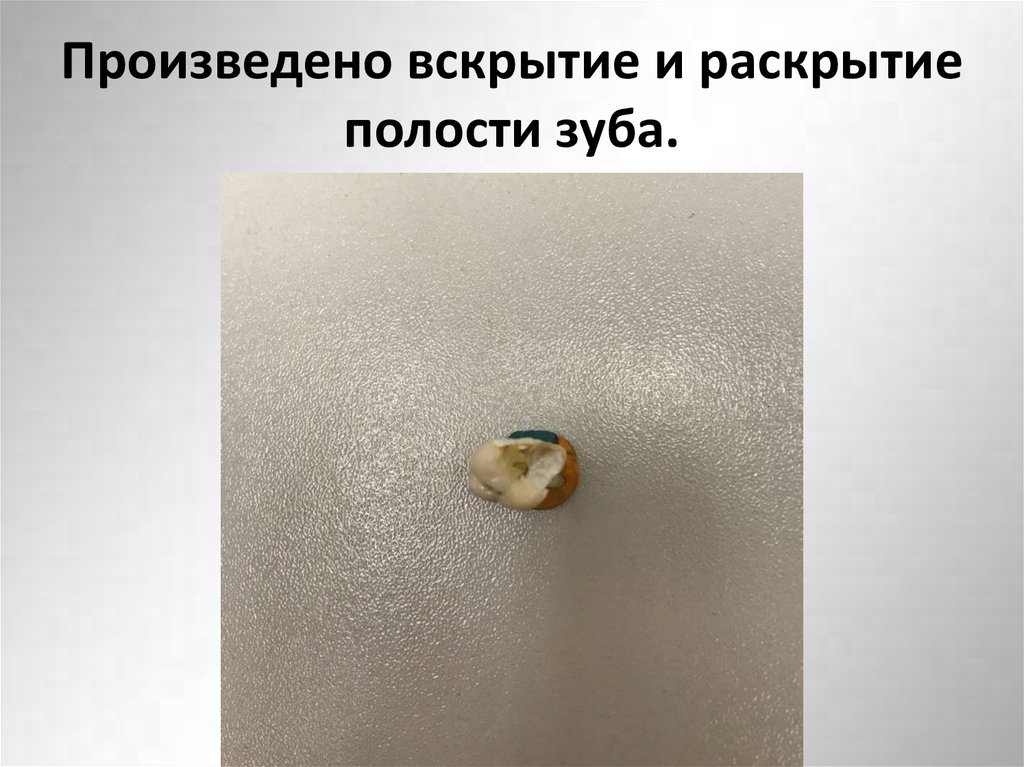 Произведено вскрытие и раскрытие полости зуба.