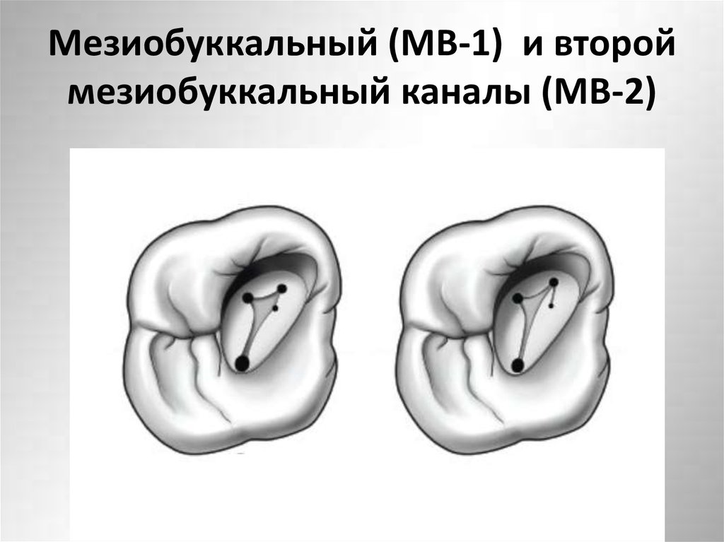 Мезиобуккальный (МВ-1) и второй мезиобуккальный каналы (МВ-2)