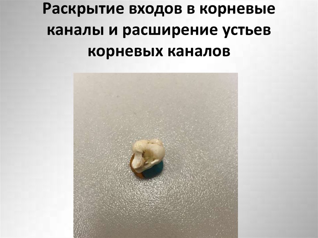 Раскрытие входов в корневые каналы и расширение устьев корневых каналов