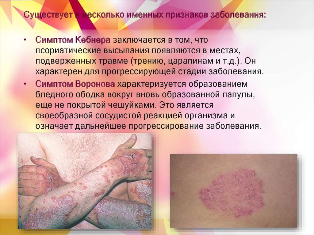 Аутоиммунные заболевания кожи фото