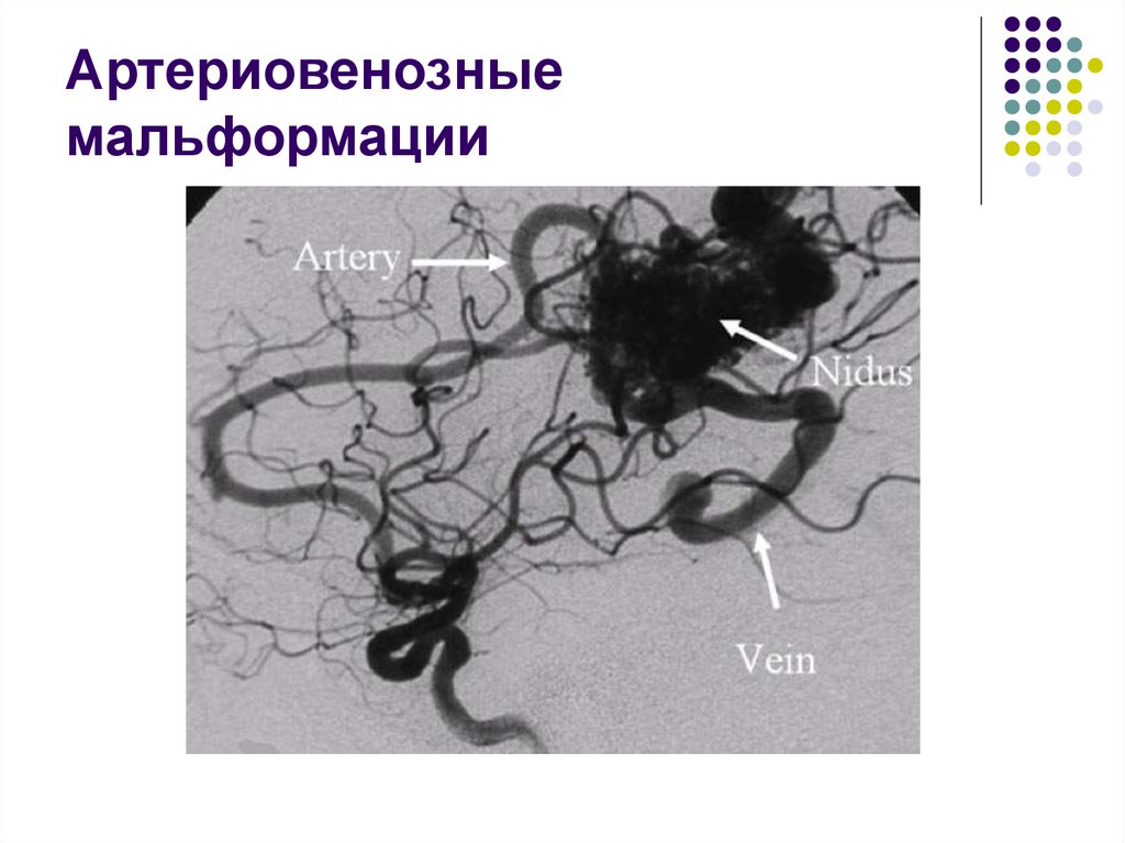 Венозная мальформация. Артериовенозная мальформация головного мозга мкб 10. Сосудистая мальформация мкб. Мальформация мкб головного мозга 10. Артериовенозные мальформации головного мозга классификация.