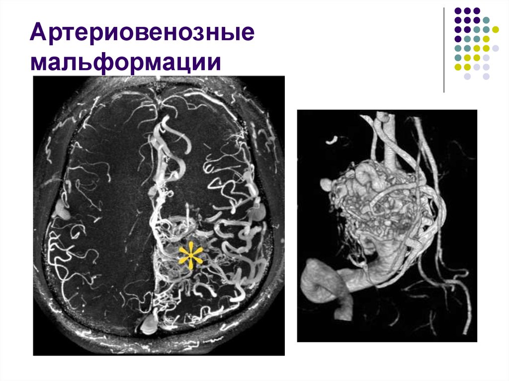 Артериовенозная мальформация фото