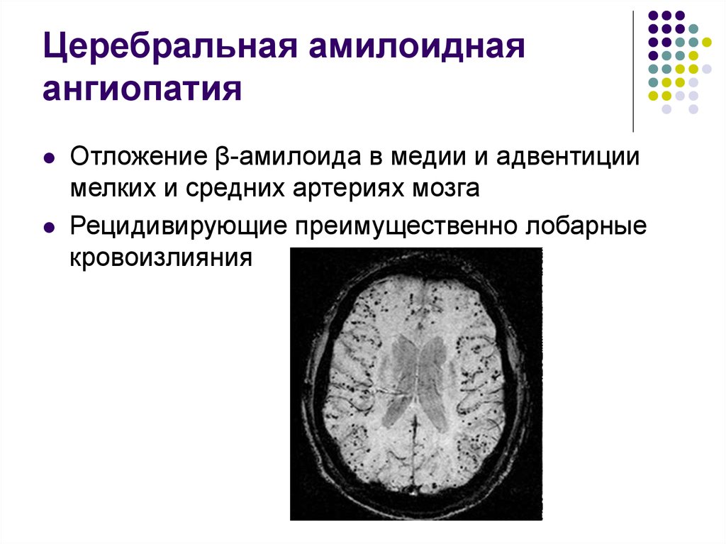 Микроангиопатия головного мозга fazekas. Очаги микроангиопатии головного мозга мрт. Церебральная амилоидная микроангиопатия мрт. Амилоидная ангиопатия головного мозга мрт. Амилоидоз головного мозга мрт.