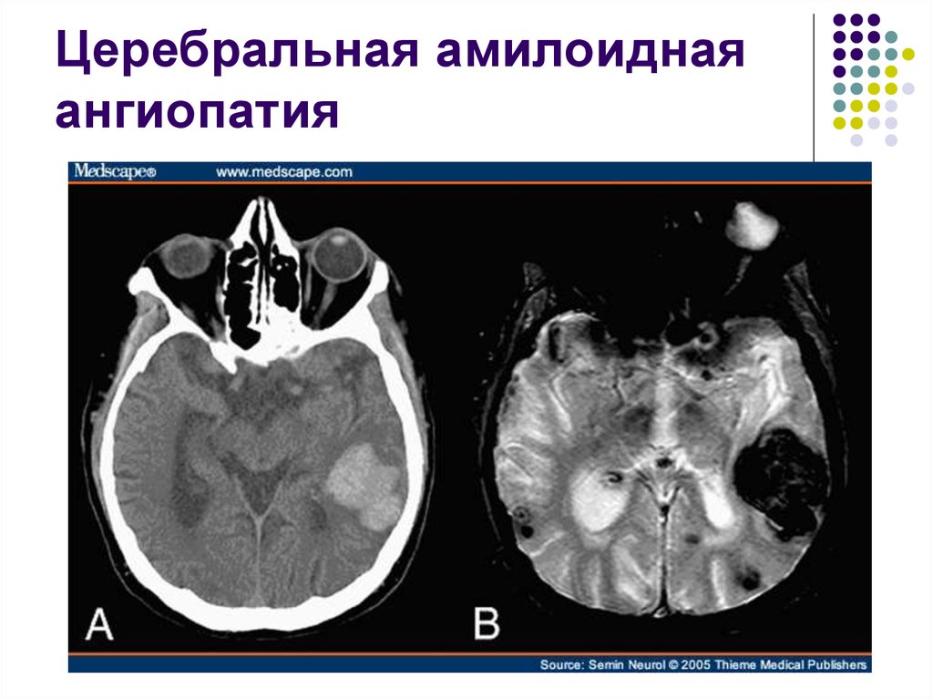 Признаки микроангиопатии головного мозга. Церебральная микроангиопатия кт. Церебральный амилоидоз. Церебральная амилоидная ангиопатия мрт. Амилоидоз головного мозга кт.
