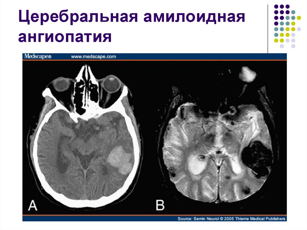 Микроангиопатия на мрт. Церебральная микроангиопатия кт. Церебральный амилоидоз. Церебральная амилоидная ангиопатия мрт. Амилоидоз головного мозга кт.