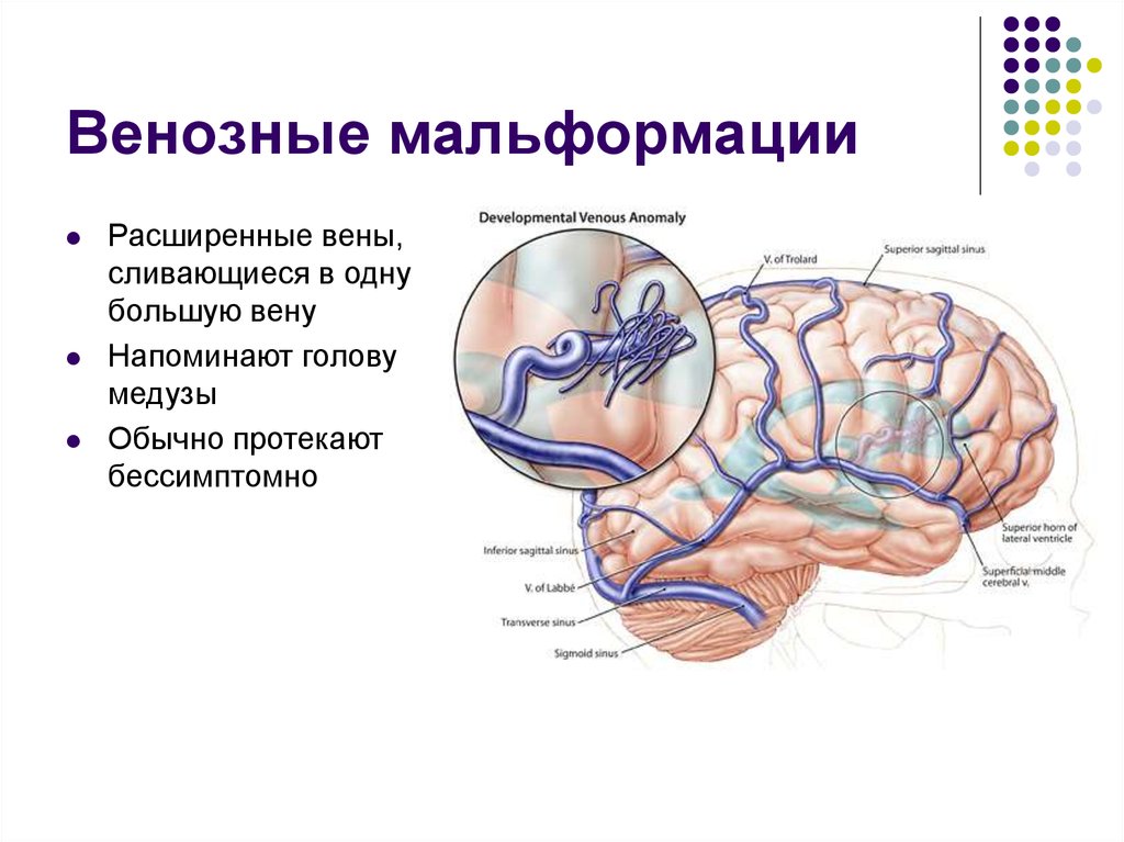 Венозная мальформация. Венозные мальформации. Венозная полиформация. Капиллярно венозная мальформация.