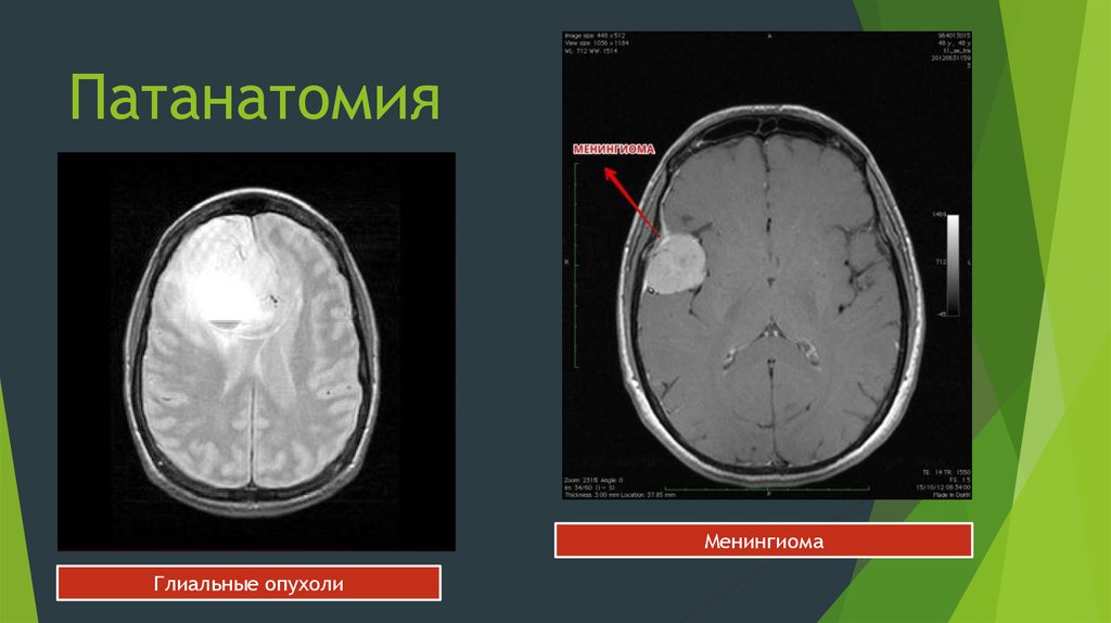 Патанатомия