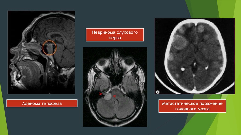 Невринома. Невринома головного мозга. Невринома зрительного нерва мрт. Метастатическое поражение головного мозга. Невринома зрительного нерва кт.
