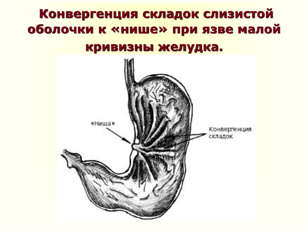 Луковица 12 перстной кишки фото