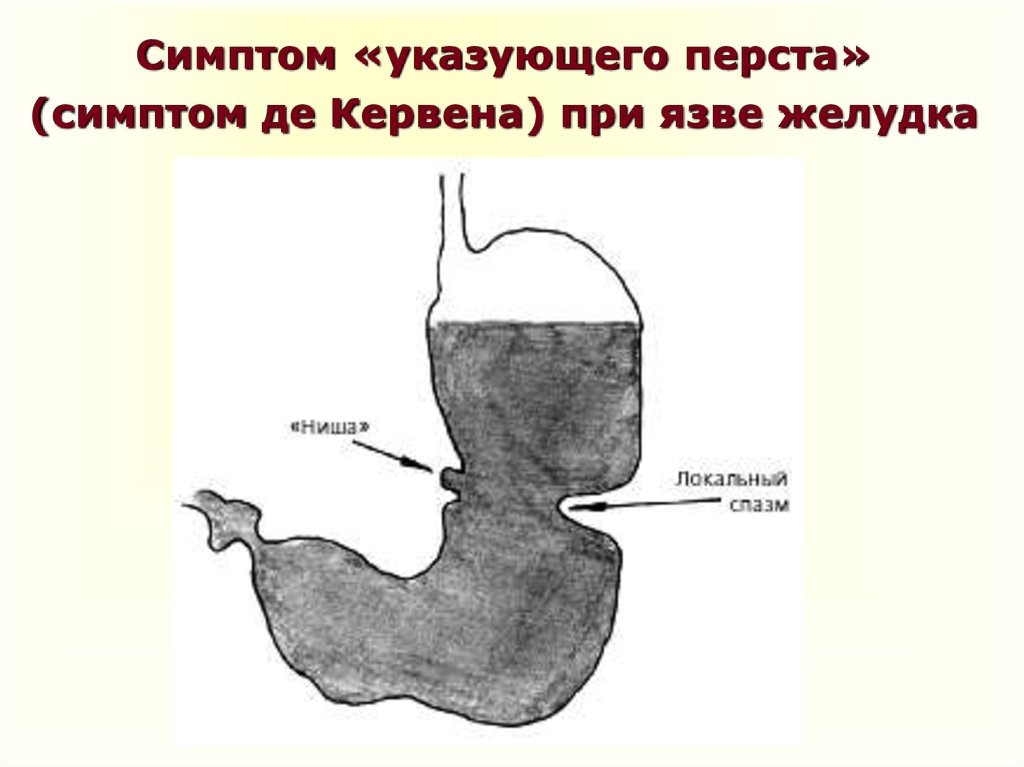 Симптом «указующего перста» (симптом де Кервена) при язве желудка