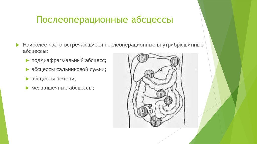 Абсцесс передней брюшной стенки карта вызова