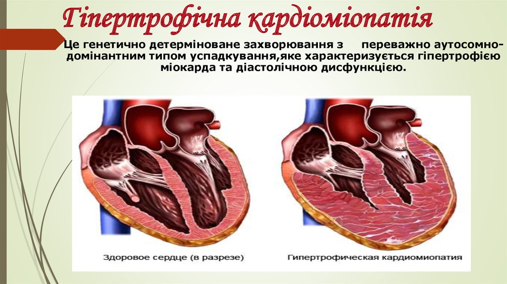 Гіпертрофічна кардіоміопатія